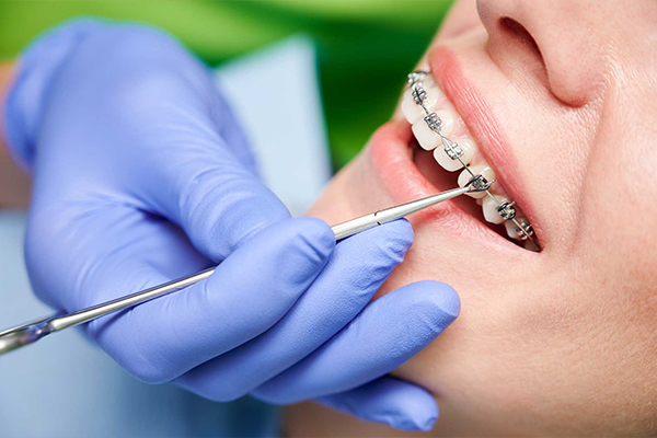 Braces Treatments