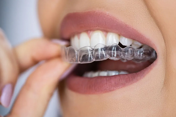 Invisible Aligners