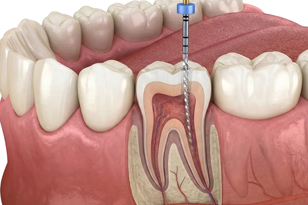Root Canal Treatment