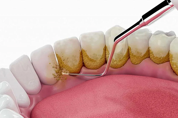 Dental Cleaning & Scaling