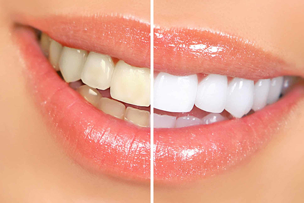 Teeth Whitening